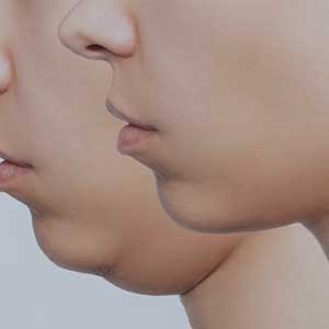 Lipolyse