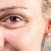 Krähenfüße mit Botox behandeln