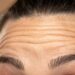 Stirnfalten glätten mit Botox (Botulinumtoxin) in Hannover