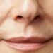 Bunny Lines glätten mit Botox – Sanfte Behandlung