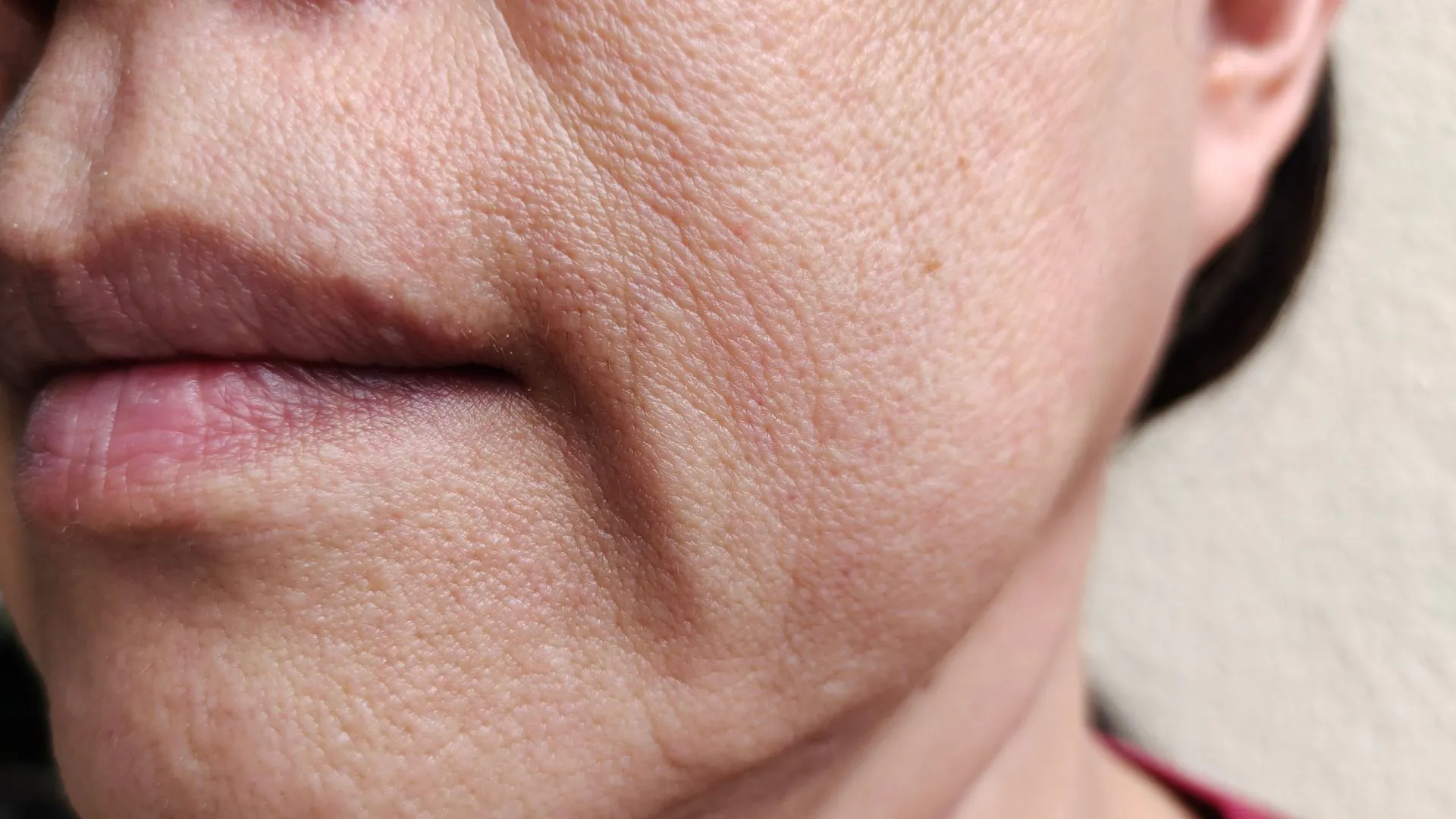 Botulinumtoxin